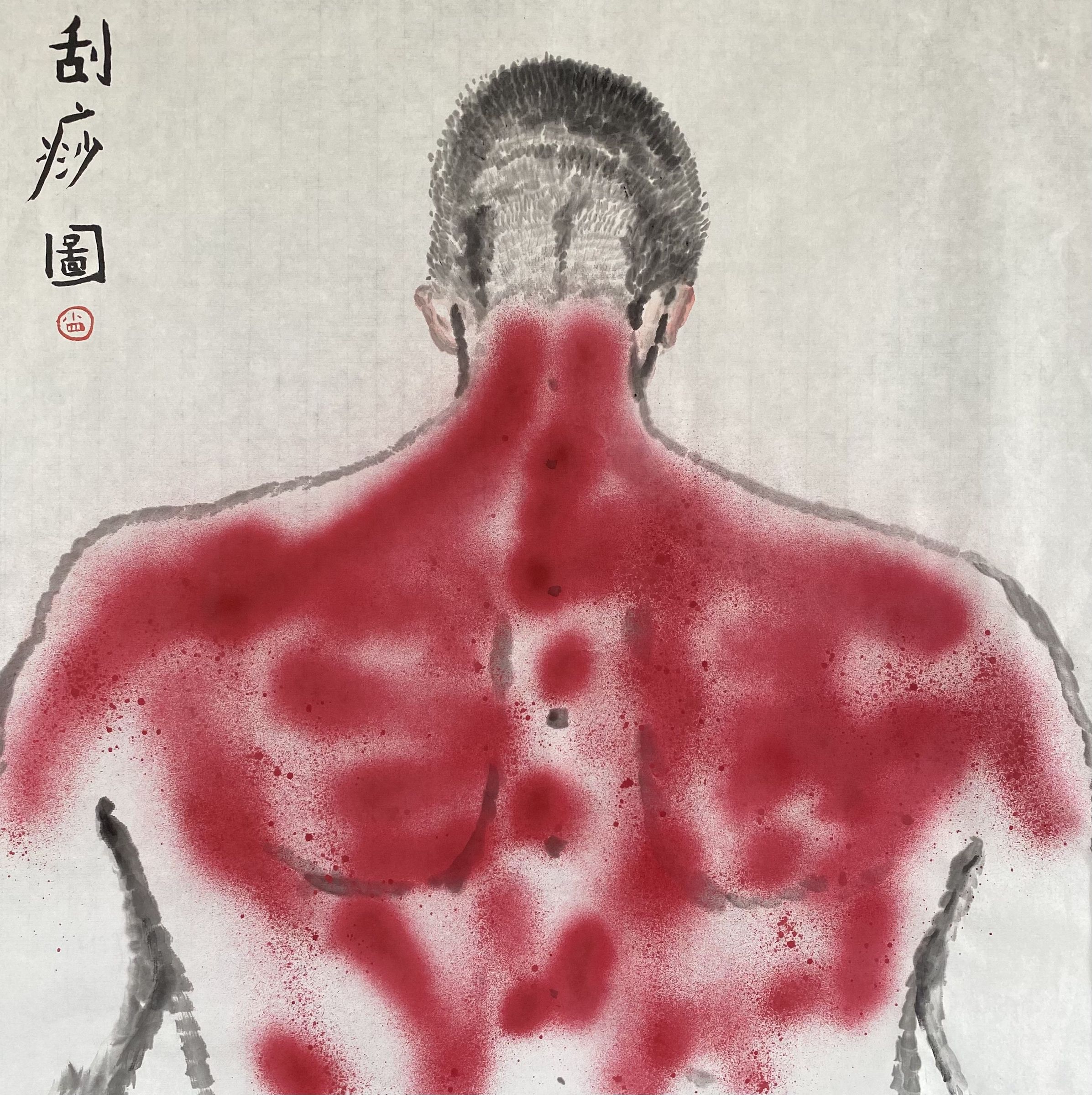 刮痧圖2